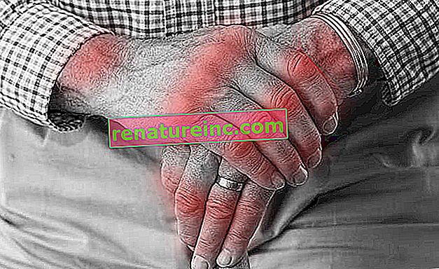 Qu'est-ce que l'arthrite: symptômes et traitements